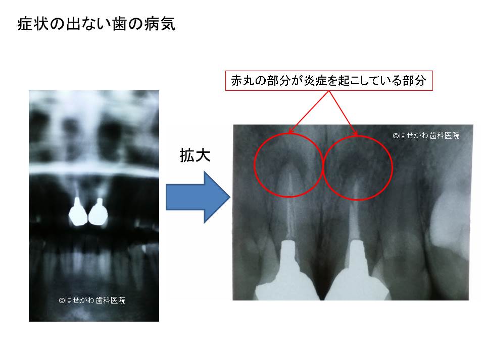 歯ぐきの炎症