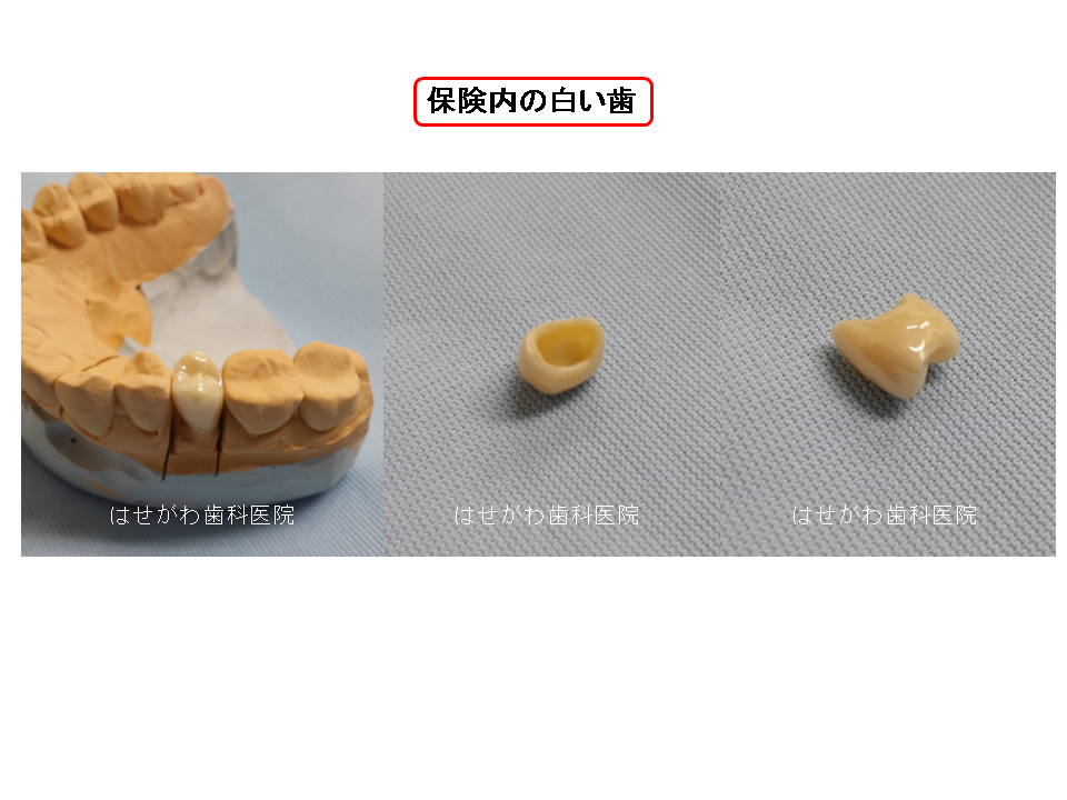 保険内で白い歯