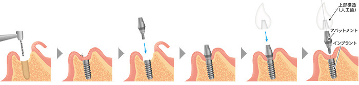 インプラントの手順