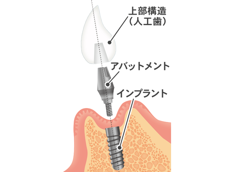 インプラントの構造